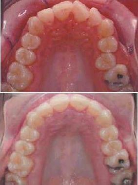 Aligner-Beispiel: frontale Drehstände und einseitige Omega-Form
