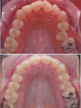 Aligner-Beispiel: frontale Drehstände und einseitige Omega-Form