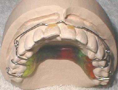Kieferorthopädische Zahn-Verlängerung, herausnehmbar
