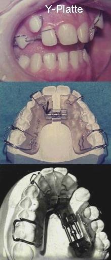 Zahnspangen mit frontalen Halteklammern