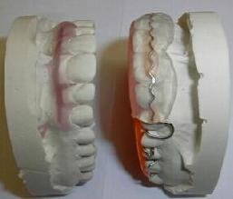 Wieder-Verkürzung zu lang gewachsener Zähne