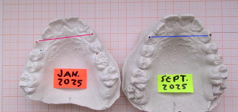 Wäre mit anderen Zahnspangen mehr Aufwand: Behebung einer Biss-Asymmetrie durch einseitige Mesialdrift (Aufwanderung der Seitenzähne) Besondere Fähigkeit vom gut passenden LM-Activator: mehr Symmetrie der Zahnpositionen herstellen